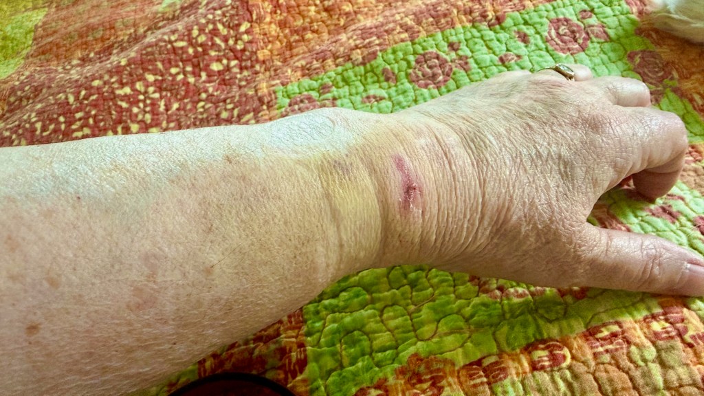 A bit of bruising on my left arm. It could have been a lot worse. Photo by author.
